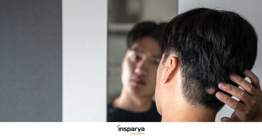 traumatic alopecia